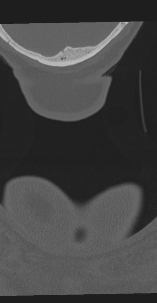 Cervical spine fracture in the setting of ankylosis (Radiopaedia 37038-38715 Coronal bone window 88).png
