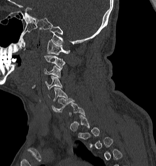 Cervical spine trauma with tear drop fracture and perched facet joint (Radiopaedia 53989-60127 Sagittal bone window 128).jpg