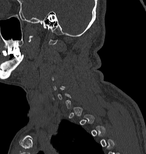 Cervical spine trauma with tear drop fracture and perched facet joint (Radiopaedia 53989-60127 Sagittal bone window 8).jpg