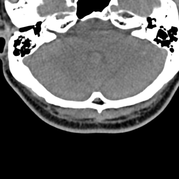 Cervical spondylodiscitis (Radiopaedia 28057-29489 Axial non-contrast 3).jpg