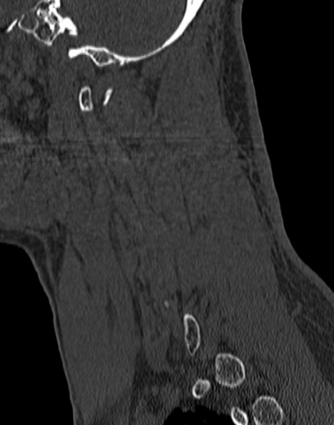 Cervical spondylodiscitis (Radiopaedia 28057-29489 Sagittal bone window 19).jpg
