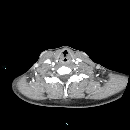 Cervical thymic cyst (Radiopaedia 88632-105335 B 44).jpg