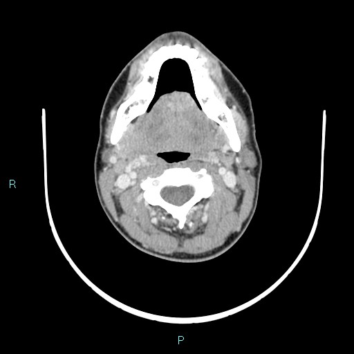 File:Cervical thymic cyst (Radiopaedia 88632-105335 C 79).jpg