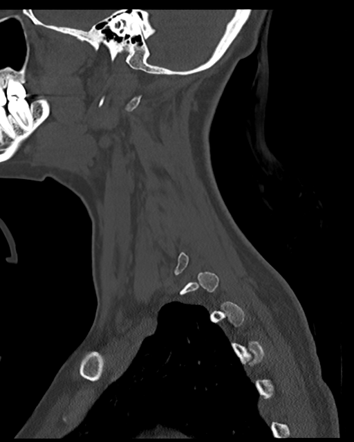Cervical tuberculous spondylitis (Radiopaedia 39149-41365 Sagittal bone window 15).png