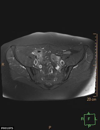 File:Cesarian scar endometriosis (Radiopaedia 68495-78066 Axial T1 C+ fat sat 6).jpg