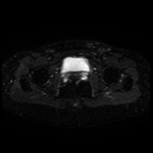File:Cesarian section scar endometriosis (Radiopaedia 66520-75799 Axial DWI 20).jpg
