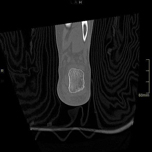 Chaput tubercle fracture (Radiopaedia 80319-93956 Coronal non-contrast 52).jpg