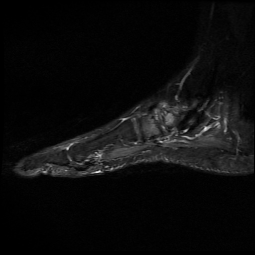 File:Charcot arthropathy (Radiopaedia 55056-61422 Sagittal T2 fat sat 4).jpg