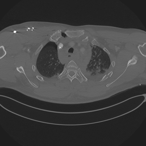Chest multitrauma - aortic injury (Radiopaedia 34708-36147 Axial bone window 65).png