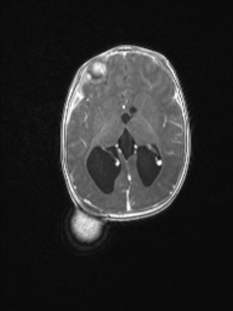 Chiari III malformation with occipital encephalocele (Radiopaedia 79446-92559 Axial T1 C+ mpr 51).jpg