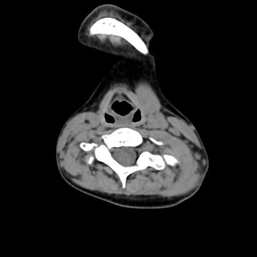 Chiari I with syrinx and skull base anomalies (Radiopaedia 89444-106412 Axial non-contrast 97).jpg