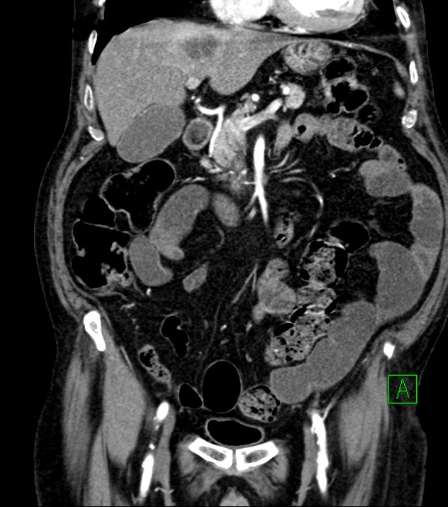 Cholangiocarcinoma with cerebral metastases (Radiopaedia 83519-98629 E 38).jpg