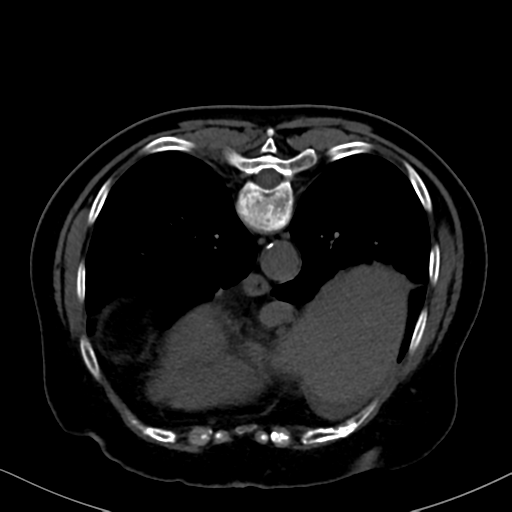 File:Cholecystitis - obstructive choledocholitiasis (CT intravenous cholangiography) (Radiopaedia 43966-47479 Axial 55).png