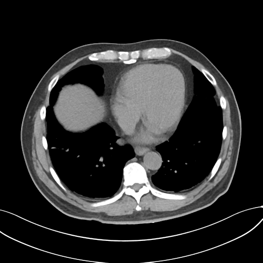 Cholecystitis with focal perforation and hepatic abscess (Radiopaedia 37189-38945 Axial non-contrast 6).png