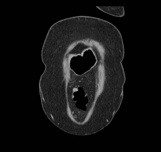 Cholecystoduodenal fistula (Radiopaedia 48959-54022 B 14).jpg