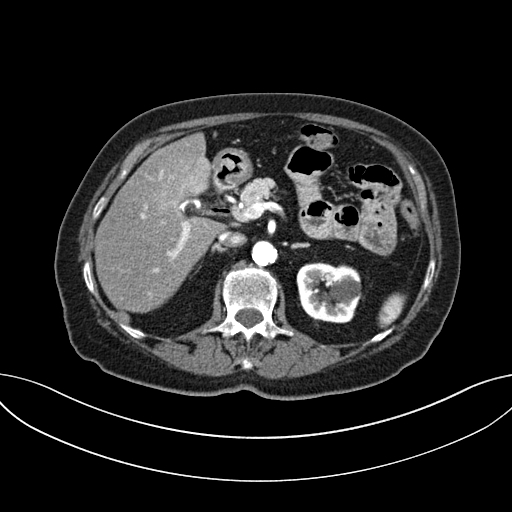 Cholecystoduodenal fistula due to calculous cholecystitis with gallstone migration (Radiopaedia 86875-103077 A 25).jpg