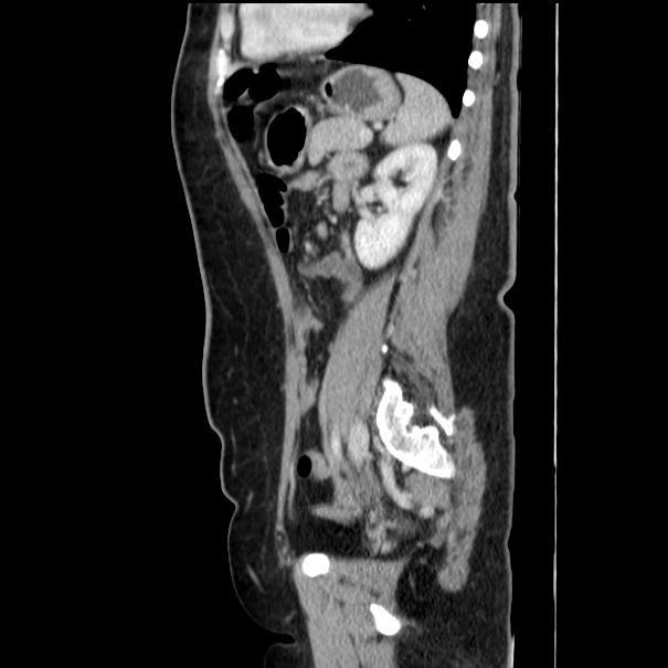 Choledocholithiasis on CT and MRI (Radiopaedia 24825-25087 D 42).jpg