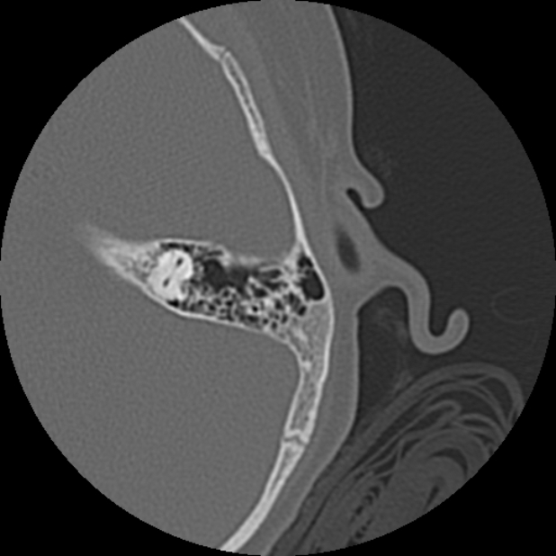 Cholesteatoma (Radiopaedia 73023-83750 Axial Left ear 64).jpg