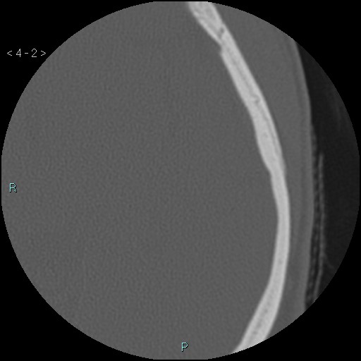 File:Cholesterol granuloma of the petrous apex (Radiopaedia 64358-73141 Axial bone window 1).jpg