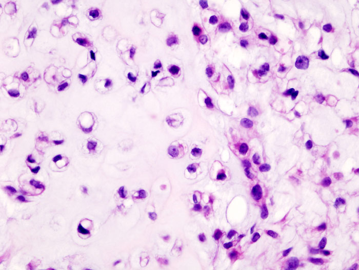 File:Chondrosarcoma (histology) (Radiopaedia 36352-37907 B 1).jpg