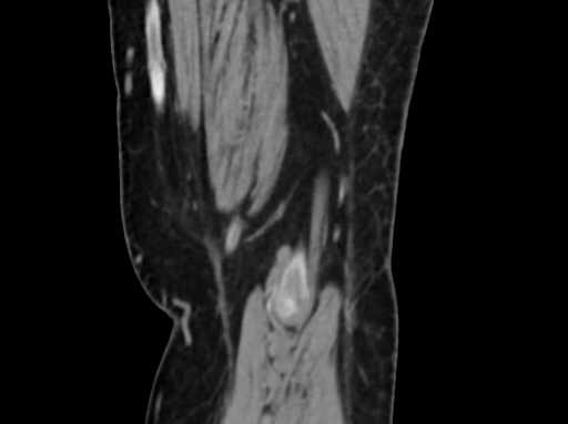 Chondrosarcoma - femur (Radiopaedia 64187-72954 C 59).jpg
