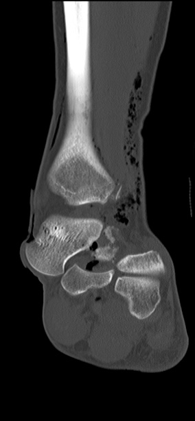 Chopart fracture (Radiopaedia 35347-36851 Coronal bone window 39).jpg
