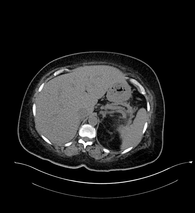 Chromophobe renal cell carcinoma (Radiopaedia 84239-99519 Axial non-contrast 46).jpg