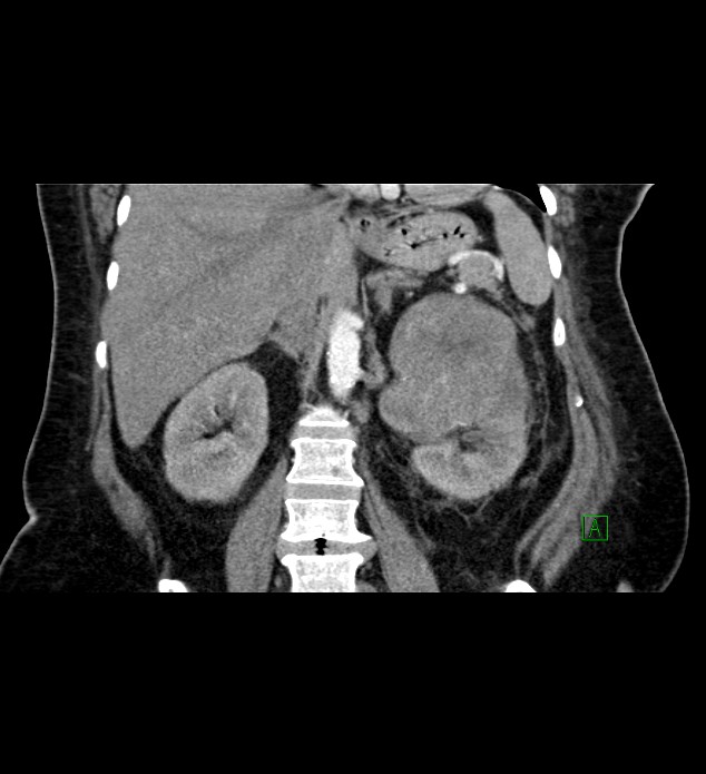 Chromophobe renal cell carcinoma (Radiopaedia 84239-99519 C 54).jpg