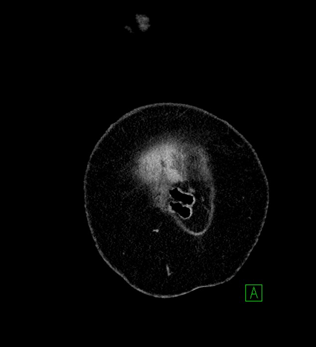 Chromophobe renal cell carcinoma (Radiopaedia 84239-99519 F 2).jpg