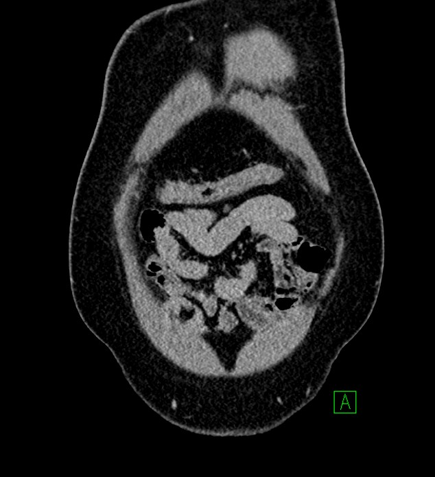 Chromophobe renal cell carcinoma (Radiopaedia 84286-99573 H 21).jpg