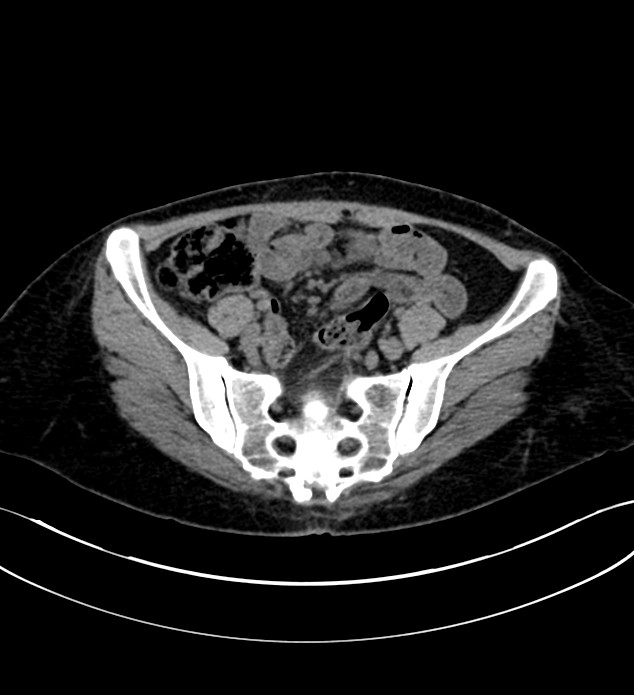 Chromophobe renal cell carcinoma (Radiopaedia 84290-99582 Axial non-contrast 113).jpg