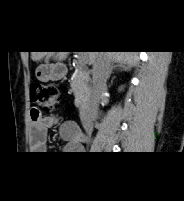 Chromophobe renal cell carcinoma (Radiopaedia 84290-99582 D 59).jpg