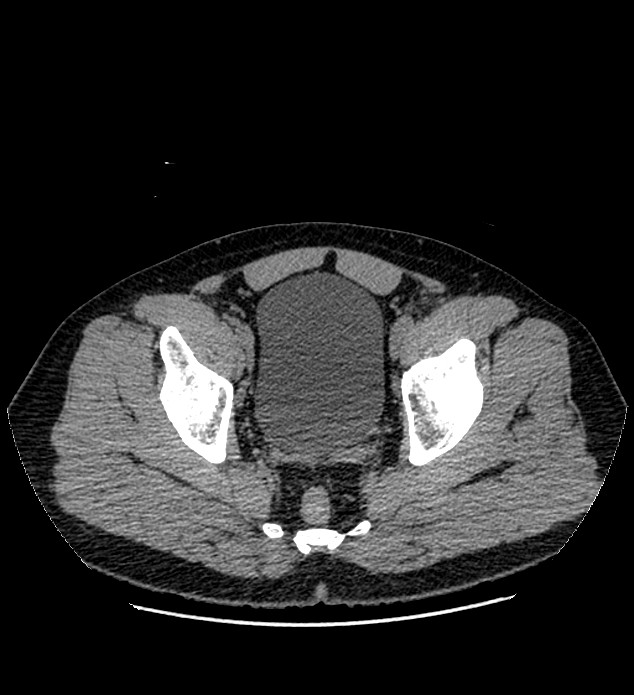 Chromophobe renal cell carcinoma (Radiopaedia 84337-99693 Axial non-contrast 144).jpg