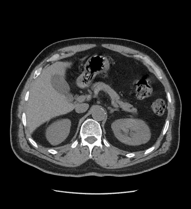 Chromophobe renal cell carcinoma (Radiopaedia 86879-103083 Axial non-contrast 21).jpg