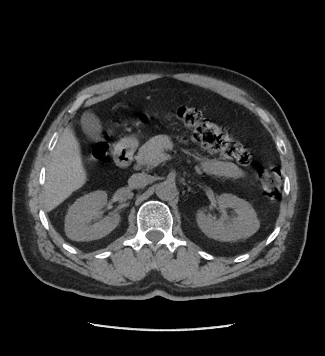 Chromophobe renal cell carcinoma (Radiopaedia 86879-103083 Axial non-contrast 30).jpg