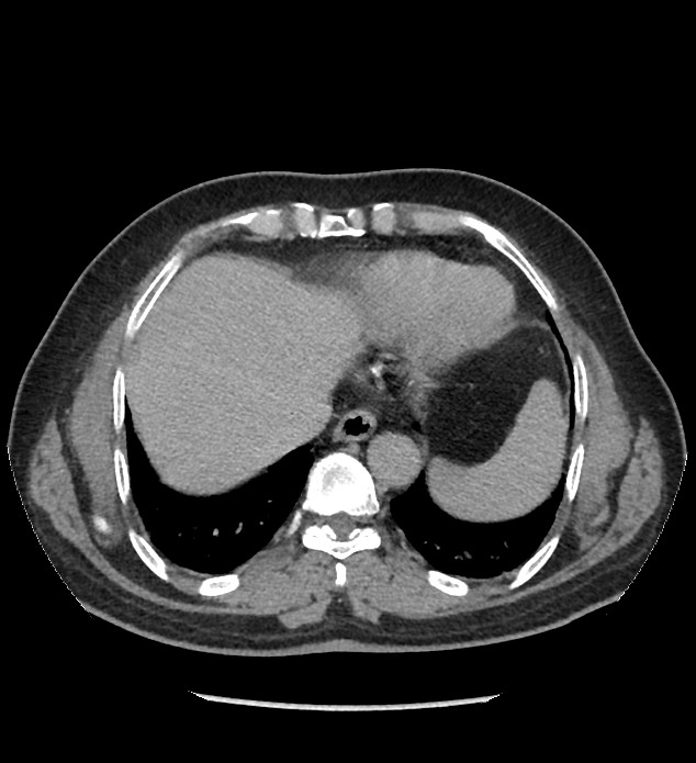 Chromophobe renal cell carcinoma (Radiopaedia 86879-103083 D 10).jpg