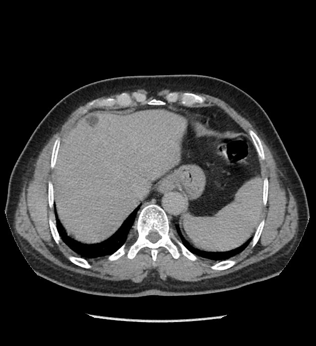 Chromophobe renal cell carcinoma (Radiopaedia 86879-103083 D 17).jpg