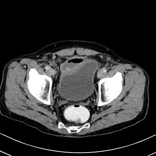 Chronic appendicitis complicated by appendicular abscess, pylephlebitis and liver abscess (Radiopaedia 54483-60700 B 131).jpg