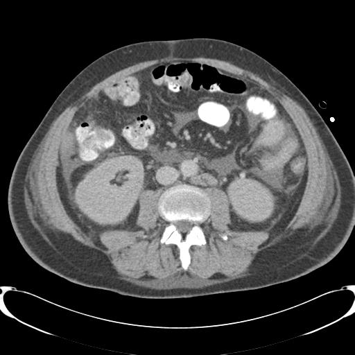 Chronic diverticulitis complicated by hepatic abscess and portal vein thrombosis (Radiopaedia 30301-30938 A 52).jpg