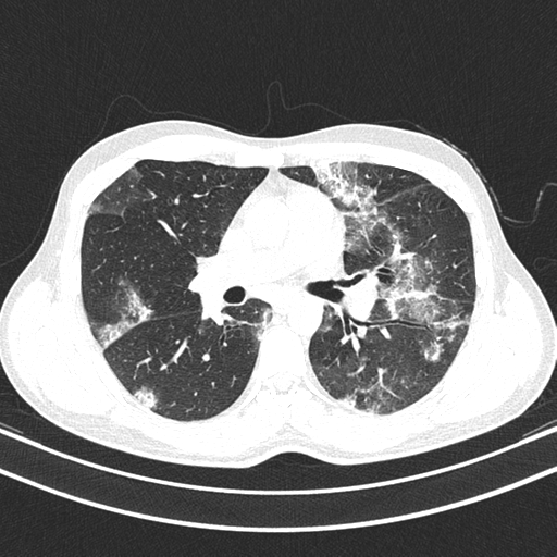 Chronic eosinophilic pneumonia (Radiopaedia 39331-41587 Axial lung window 24).png