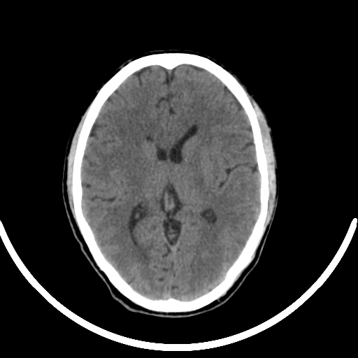 File:Chronic invasive fungal sinusitis with intraorbital and intracranial extension (Radiopaedia 56387-63046 Axial non-contrast 214).jpg