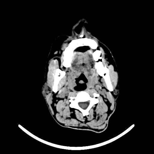 File:Chronic invasive fungal sinusitis with intraorbital and intracranial extension (Radiopaedia 56387-63046 Axial non-contrast 5).jpg