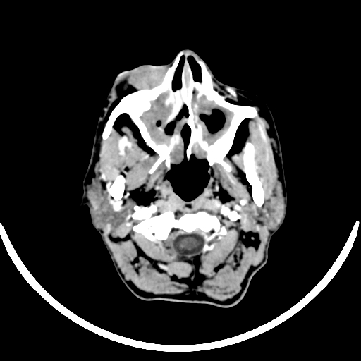 Chronic invasive fungal sinusitis with intraorbital and intracranial extension (Radiopaedia 56387-63046 B 34).jpg
