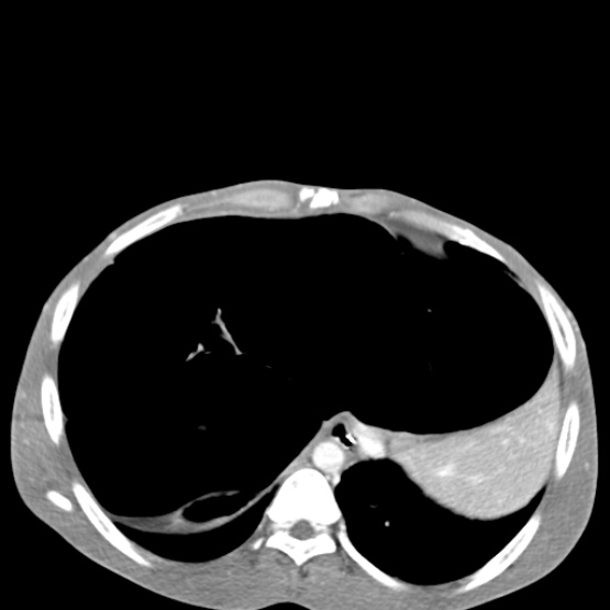 Chronic large bowel pseudo-obstruction (Radiopaedia 43181-46492 A 36).jpg