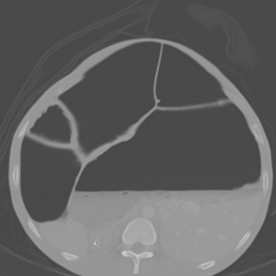 File:Chronic large bowel pseudo-obstruction (Radiopaedia 43181-46492 Axial bone window 61).jpg