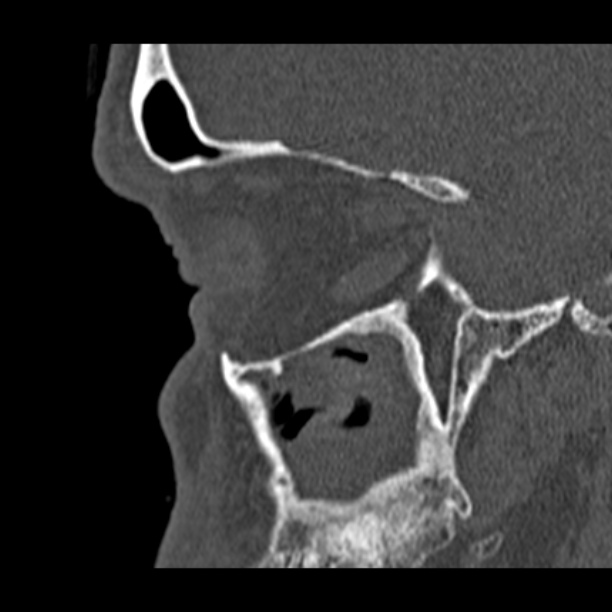Chronic maxillary sinusitis (Radiopaedia 27879-28116 Sagittal bone window 13).jpg