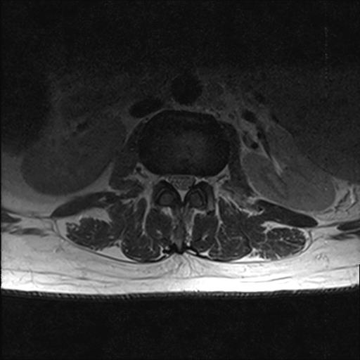 File:Chronic myeloid leukemia (MRI) (Radiopaedia 56128-62777 Axial T2 12).jpg