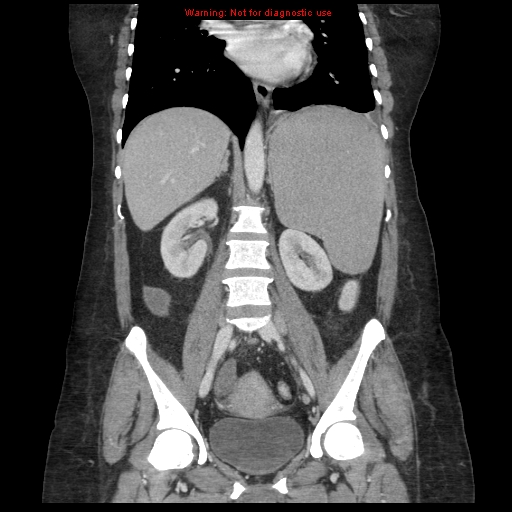 File:Chronic myeloid leukemia with splenic infarction (Radiopaedia 9178-9874 E 44).jpg