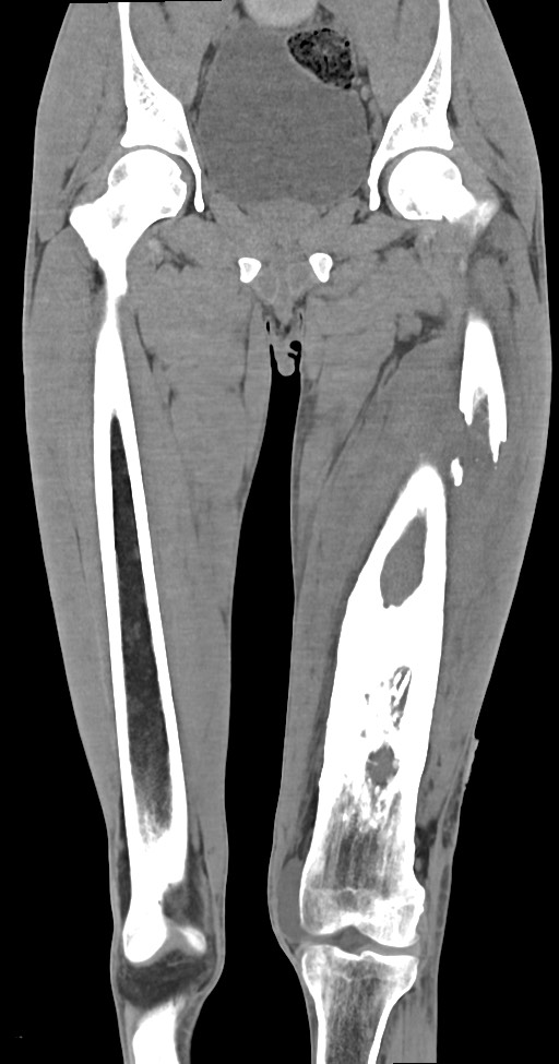 Chronic osteomyelitis (with sequestrum) (Radiopaedia 74813-85822 E 24).jpg