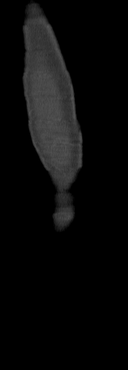 Chronic osteomyelitis of the distal humerus (Radiopaedia 78351-90971 Sagittal bone window 69).jpg